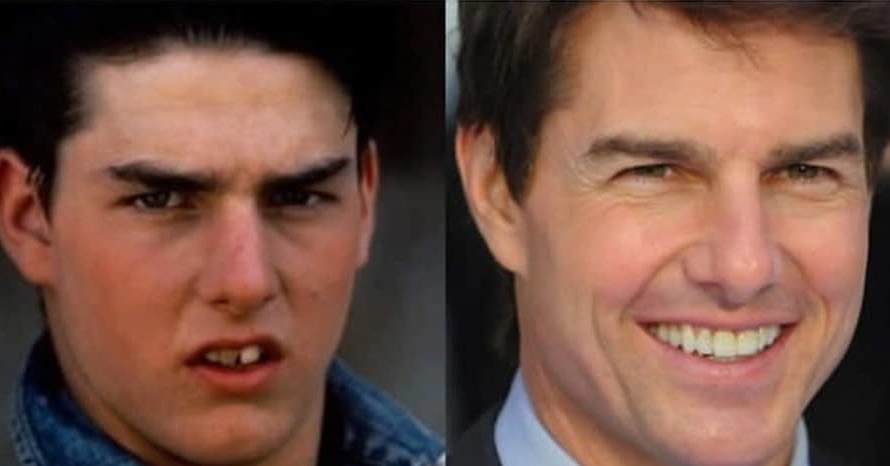 Tom Cruise Ortodoncia Antes y despues