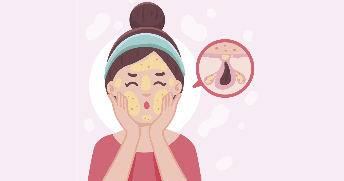 persona sufriendo de acne