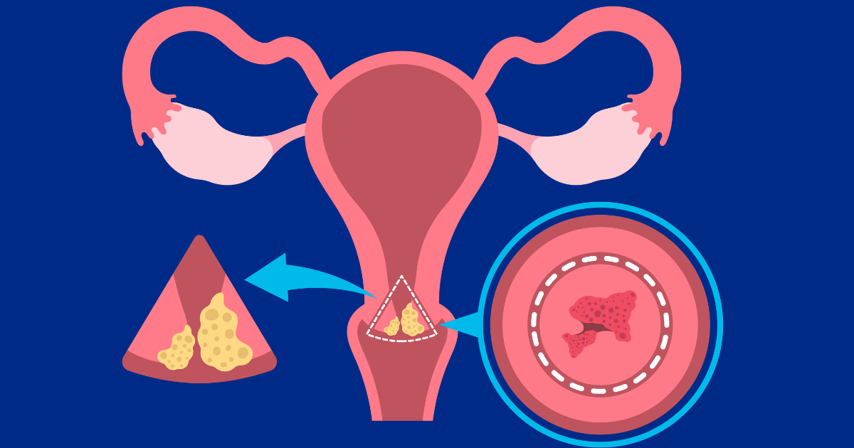 Endometrio, un cáncer cada vez más común del que apenas se habla